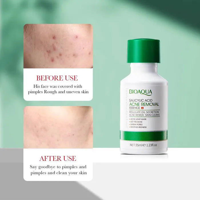 BIOAQUA Salicylic Acid Acne Removal Essence Serum - 35ml - Buy Online in Pakistan at Cosmia.pk