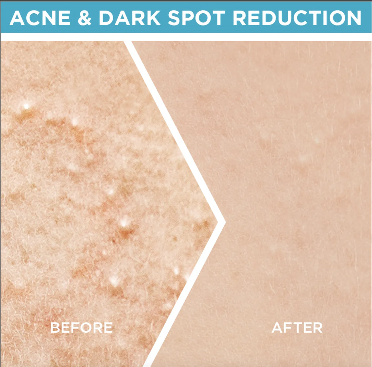 Garnier Skin Active Fast Clear Booster Serum For Acne Prone Skin - Buy Online in Pakistan at Cosmia.pk