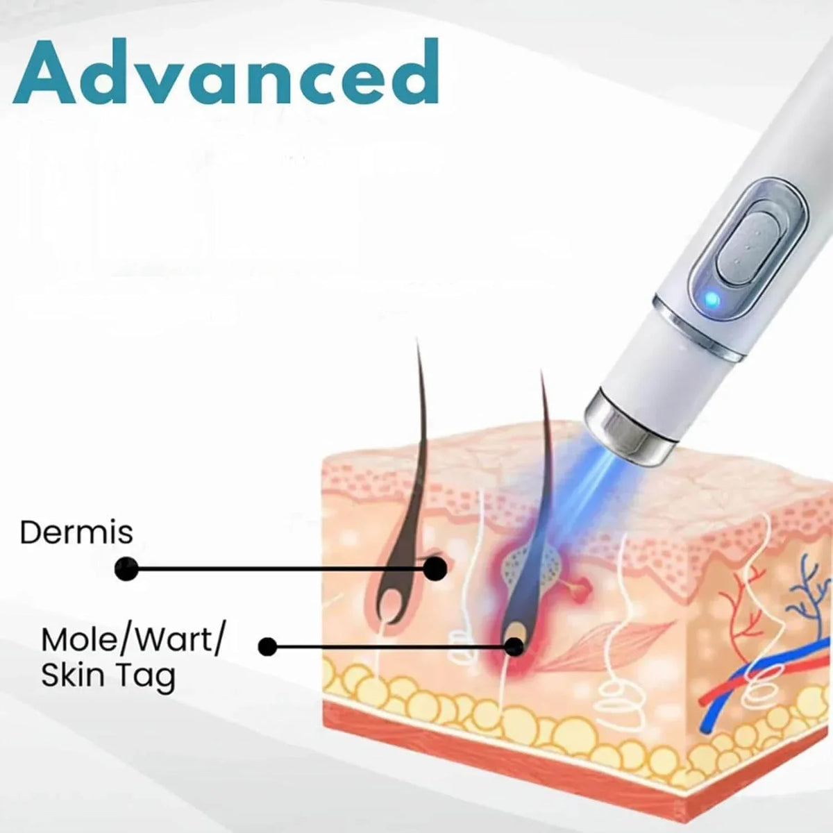 Non-Invasive Mole and Wart Removal Pen - Buy Online in Pakistan at Cosmia.pk