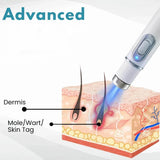 Non-Invasive Mole and Wart Removal Pen - Buy Online in Pakistan at Cosmia.pk