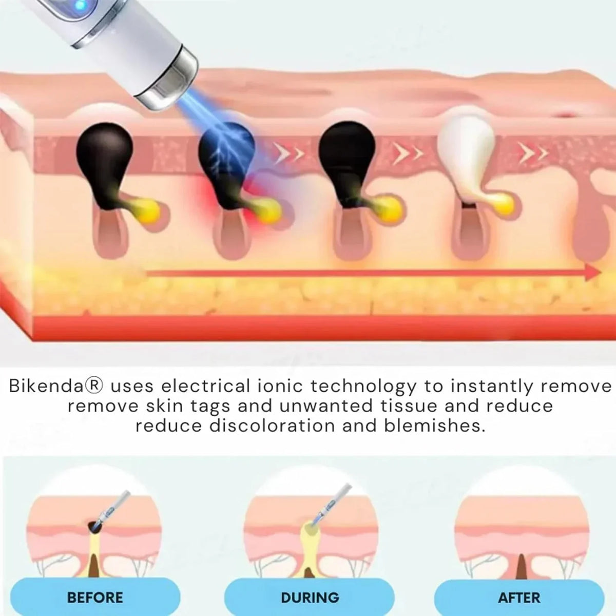 Non-Invasive Mole and Wart Removal Pen - Buy Online in Pakistan at Cosmia.pk