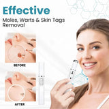 Non-Invasive Mole and Wart Removal Pen - Buy Online in Pakistan at Cosmia.pk