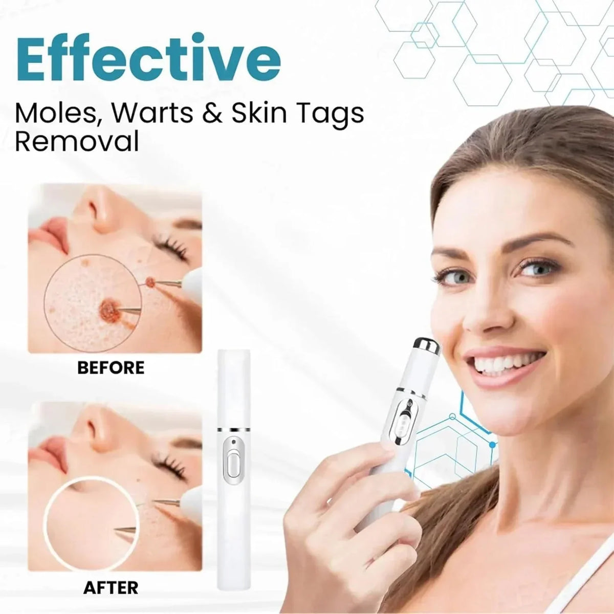 Non-Invasive Mole and Wart Removal Pen - Buy Online in Pakistan at Cosmia.pk