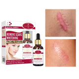 Aichun Beauty Remove Scars Whitening Facial Serum 30 ML - Buy Online in Pakistan at Cosmia.pk