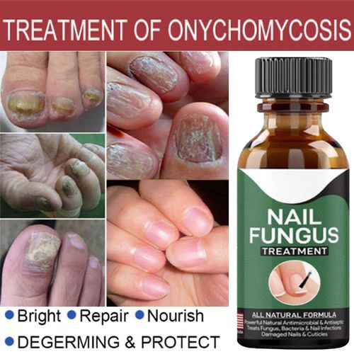 Fast Nail Fungal Treatments Nail Repair Essences Serum - Buy Online in Pakistan at Cosmia.pk