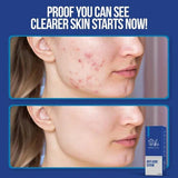 Wiki Special Anti Acne Serum - 30ml - Buy Online in Pakistan at Cosmia.pk
