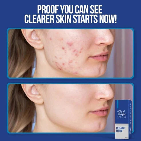 Wiki Special Anti Acne Serum - 30ml - Buy Online in Pakistan at Cosmia.pk