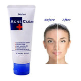 Mistine Acne Clear Facial Foam - 85ml - Buy Online in Pakistan at Cosmia.pk