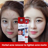 Tree Doctor Skin Acne Cream - 30g - Buy Online in Pakistan at Cosmia.pk