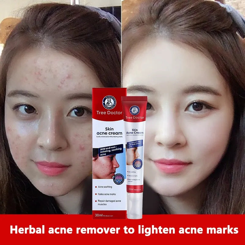 Tree Doctor Skin Acne Cream - 30g - Buy Online in Pakistan at Cosmia.pk