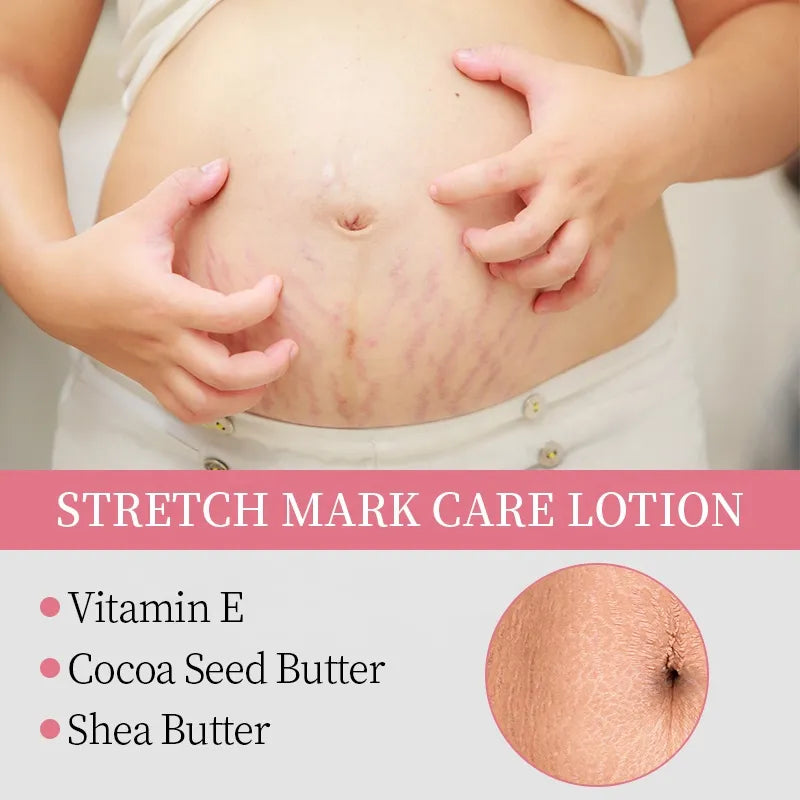 KORMESIC Stretch Mark Care Lotion – 200ml - Buy Online in Pakistan at Cosmia.pk