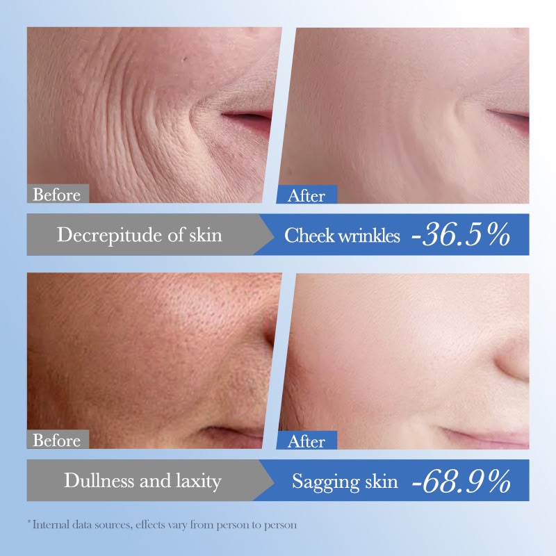 Sadoer Caviar HA anti-aging moisturizer before after — fewer cheek wrinkles, less sagging